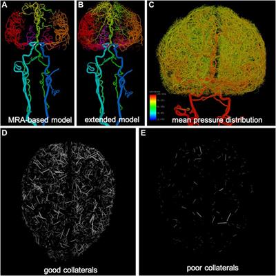 Flow reversal in distal collaterals as a possible mechanism of delayed intraparenchymal hemorrhage after flow diversion treatment of cerebral aneurysms